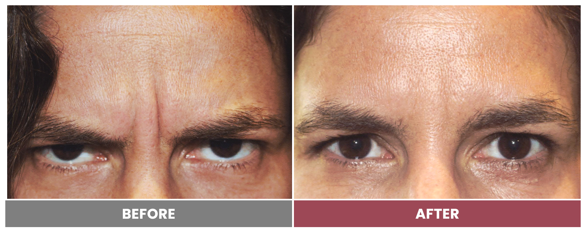 BOTOX FOR WRINKLES & BROW LIFT - Case 11